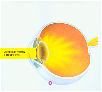 cataract-2